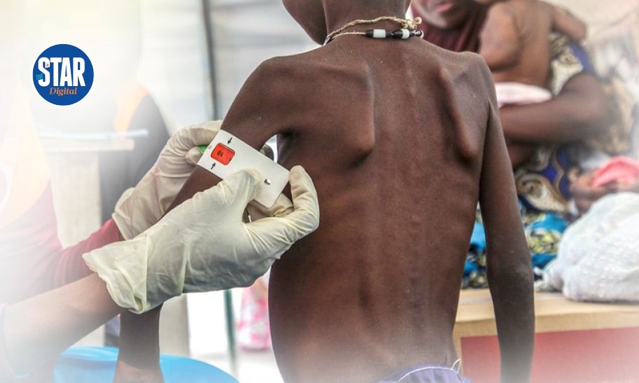 10 countries with highest malnutrition burden in children