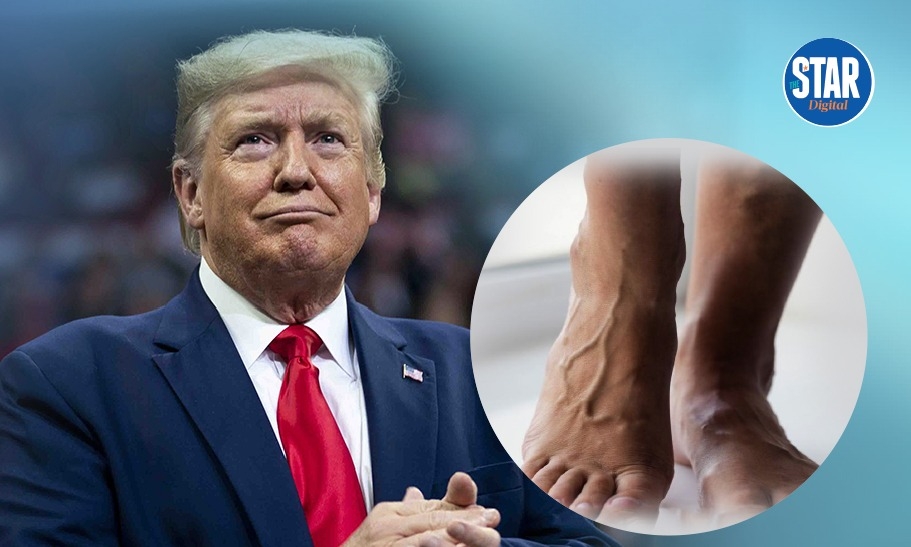 CVI: What you need to know about Trump's condition