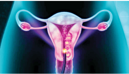 Why cervical cancer is killing more women in rural areas