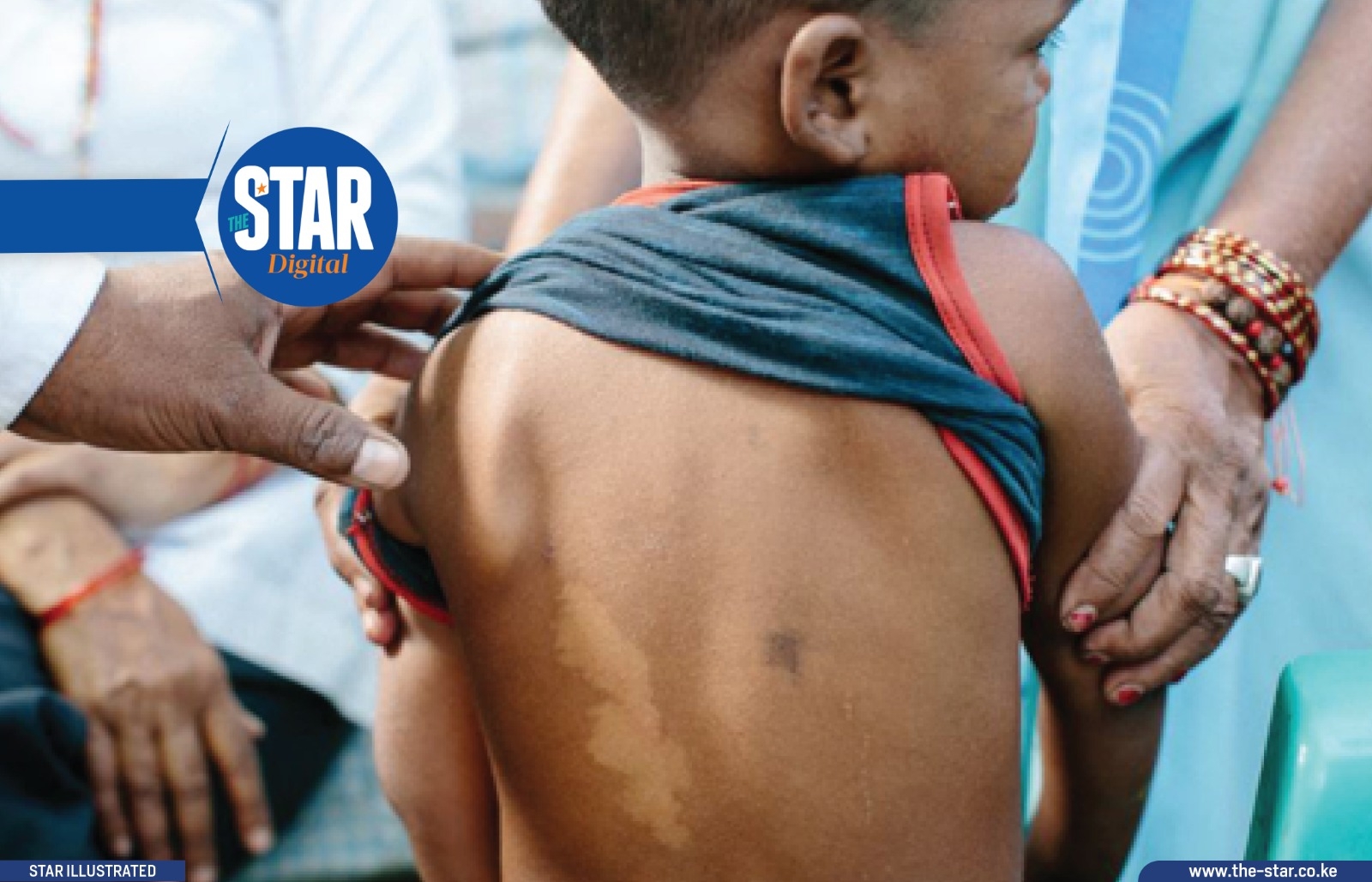 Leprosy cases in Kenya: Number of patients since 2015