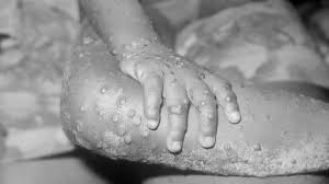 Mpox cases in Murang'a rise to 5 as officials heighten surveillance
